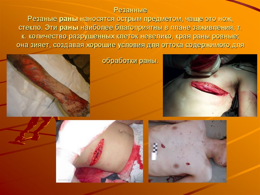 Резанные Резаные раны наносятся острым предметом, чаще это нож, стекло. Эти раны наиболее благоприятны в плане заживления, т.