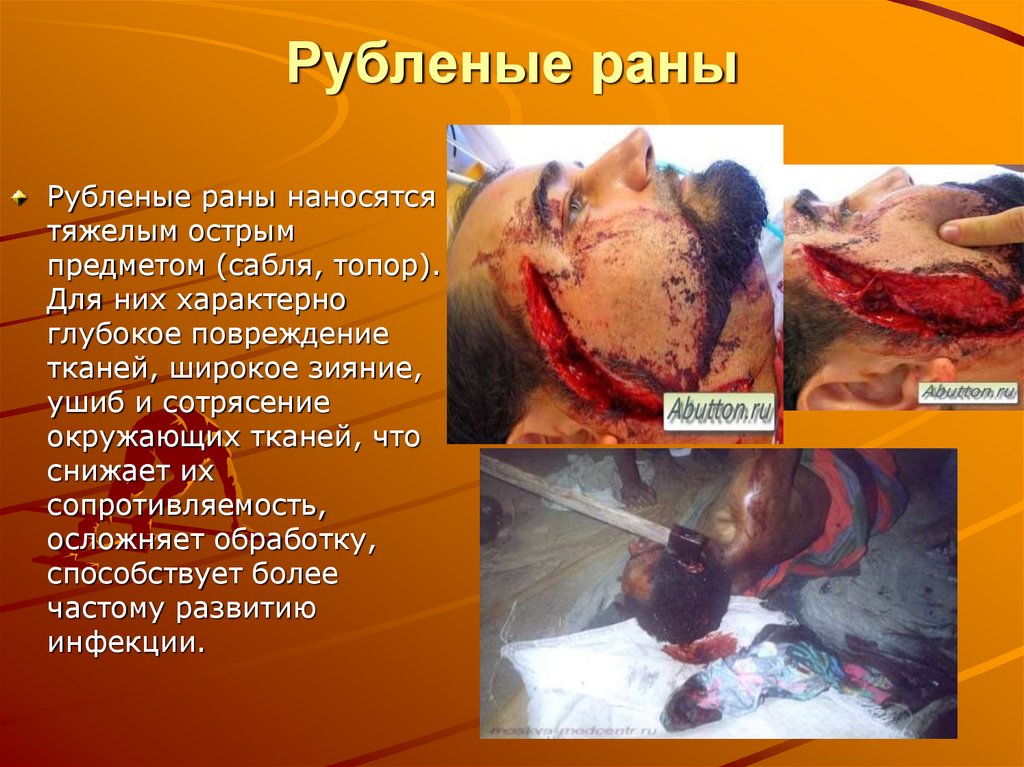 Рубленые раны