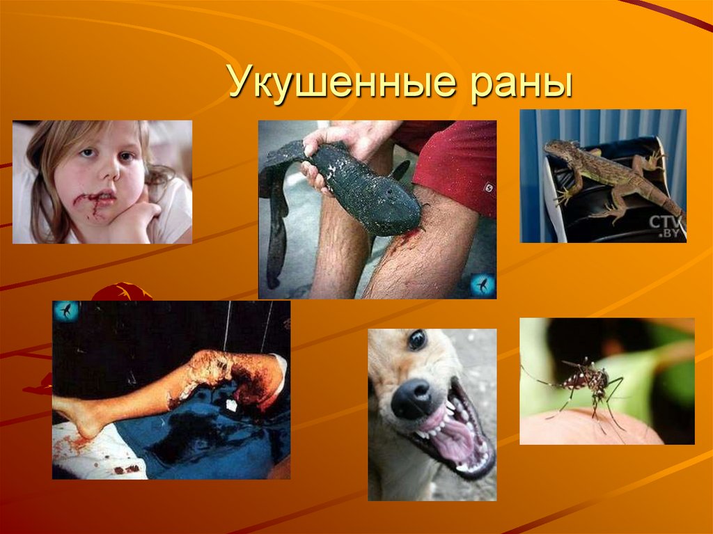 Укушенные раны