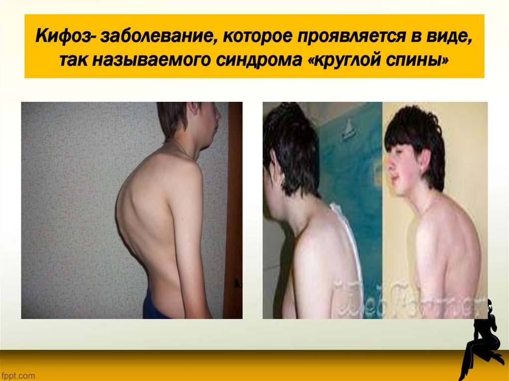 Кифоз- заболевание, которое проявляется в виде, так называемого синдрома «круглой спины»