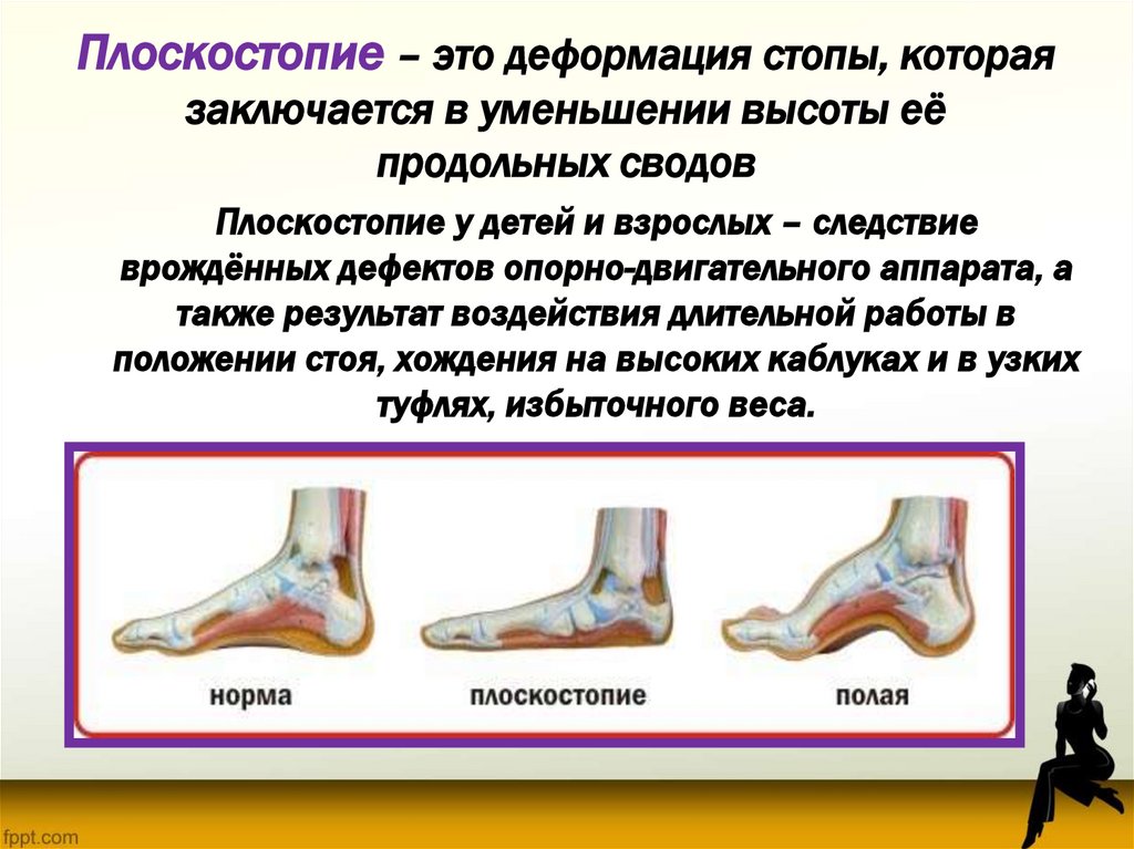 Плоскостопие – это деформация стопы, которая заключается в уменьшении высоты её продольных сводов