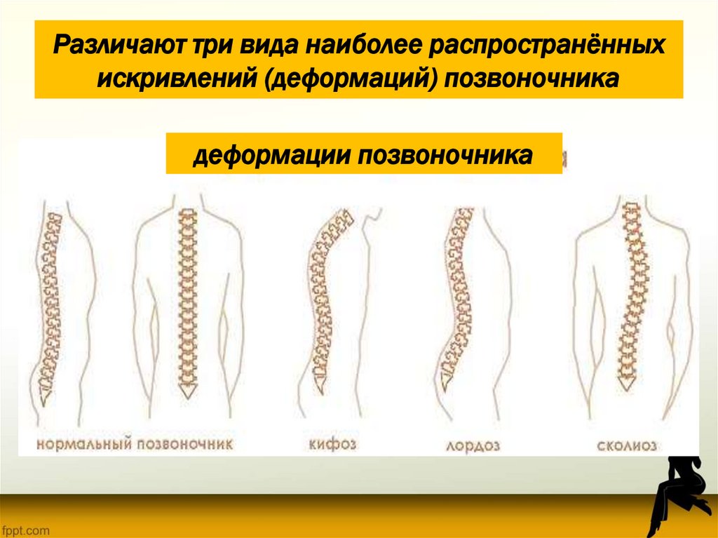 Различают три вида наиболее распространённых искривлений (деформаций) позвоночника