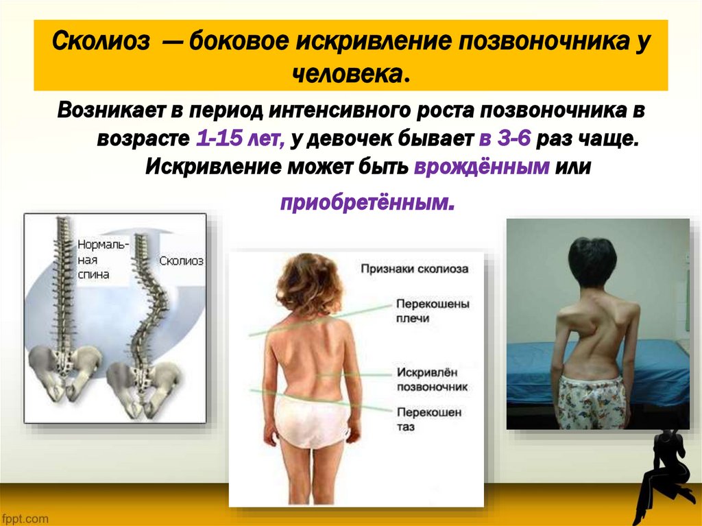 Сколиоз — боковое искривление позвоночника у человека.