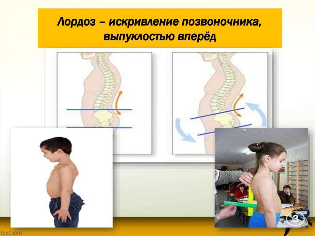 Лордоз – искривление позвоночника, выпуклостью вперёд
