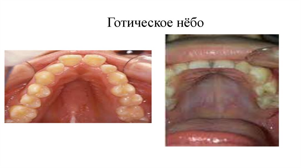 Готическое нёбо