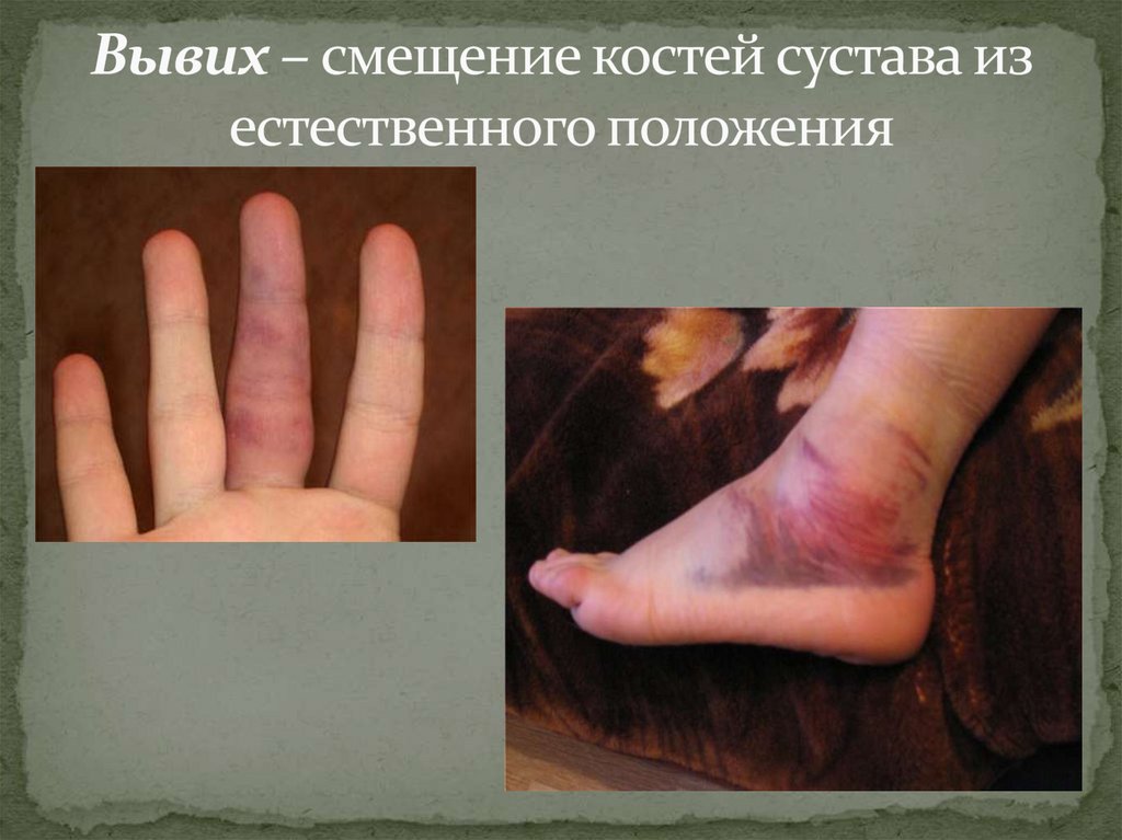 Вывих – смещение костей сустава из естественного положения