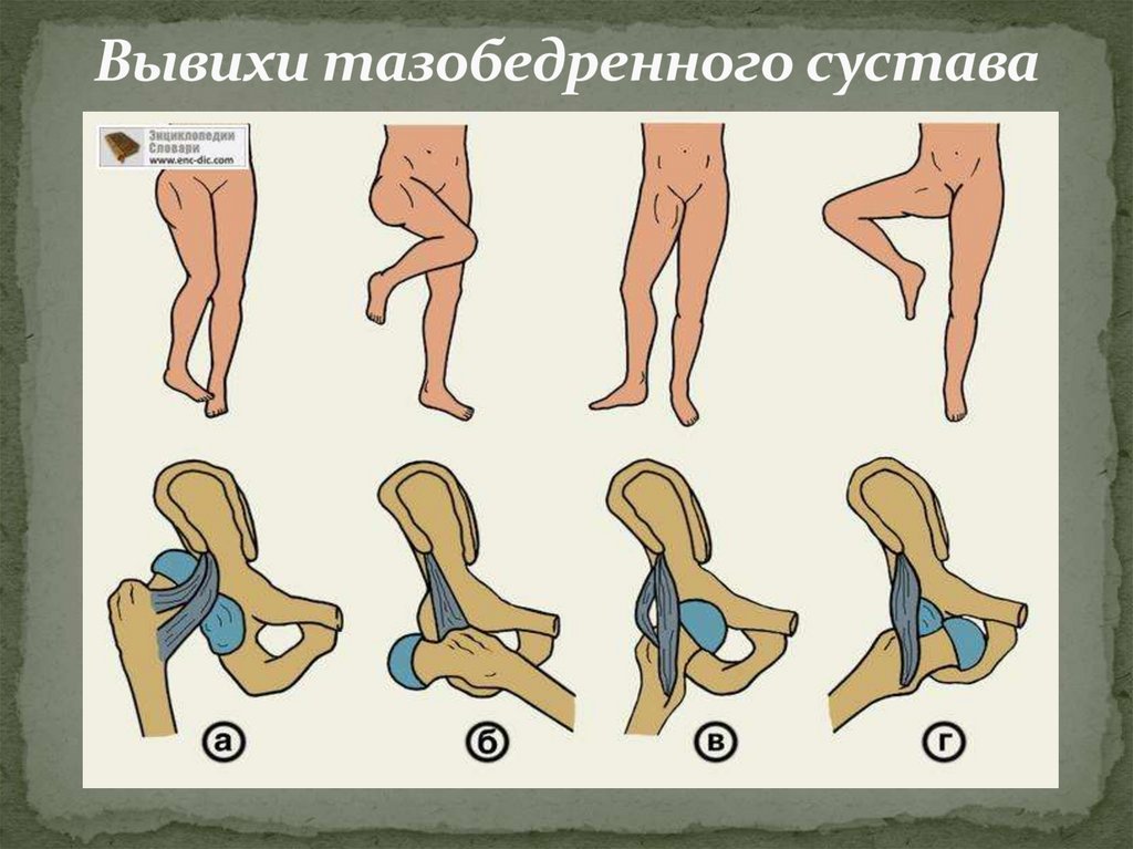 Вывихи тазобедренного сустава