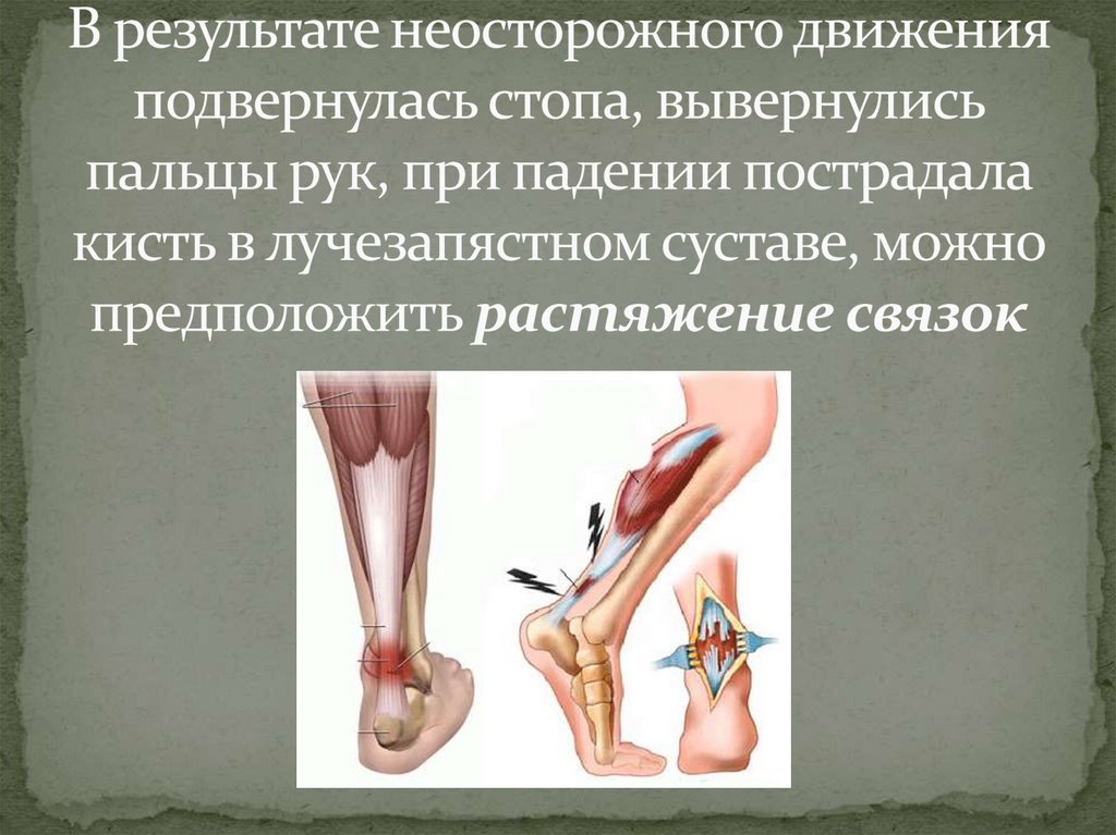 В результате неосторожного движения подвернулась стопа, вывернулись пальцы рук, при падении пострадала кисть в лучезапястном