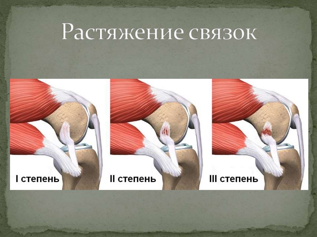 Растяжение связок