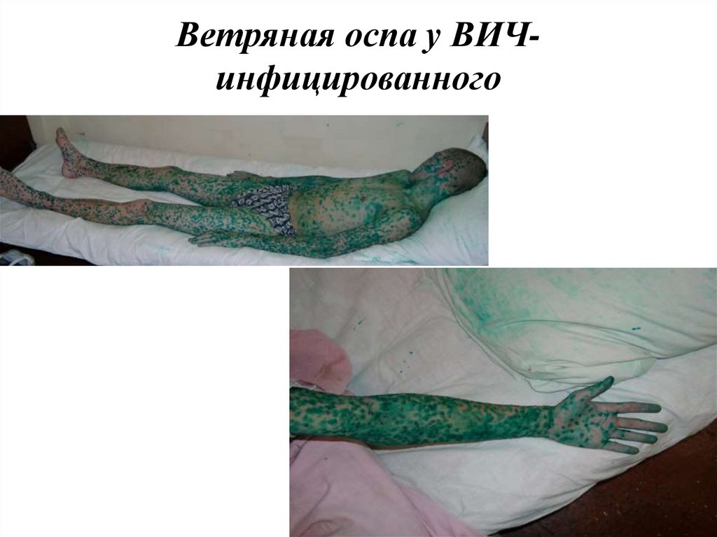 Ветряная оспа у ВИЧ-инфицированного