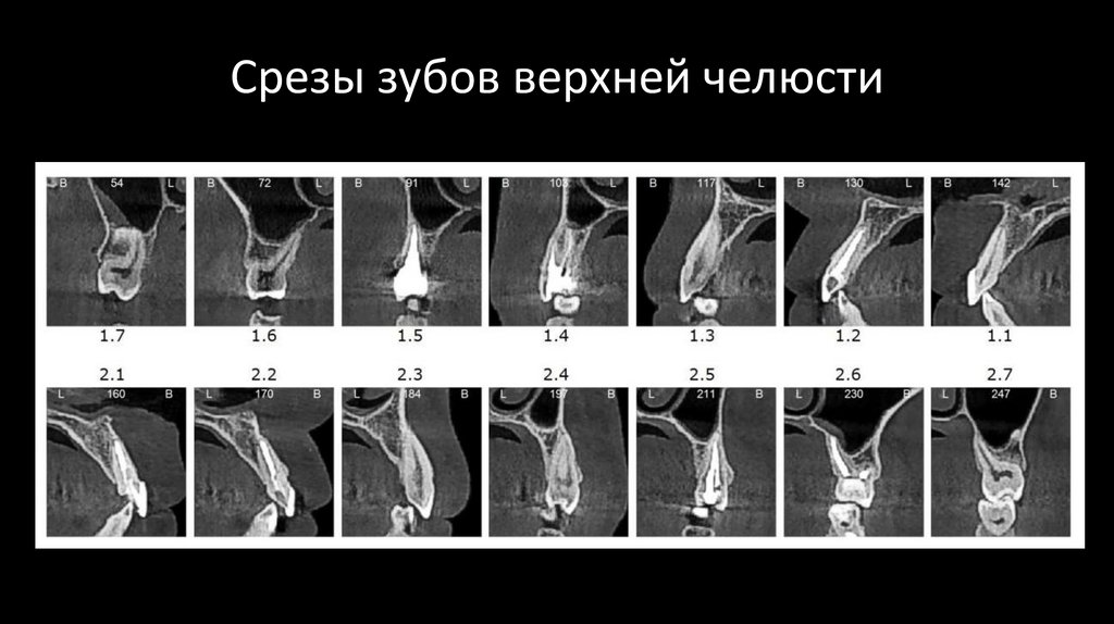 Срезы зубов верхней челюсти
