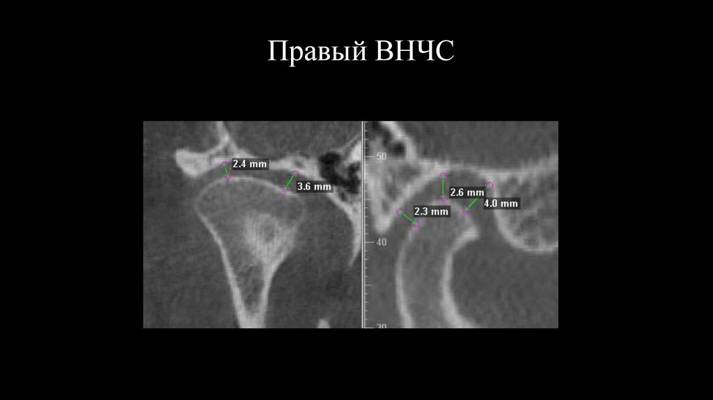 Правый ВНЧС