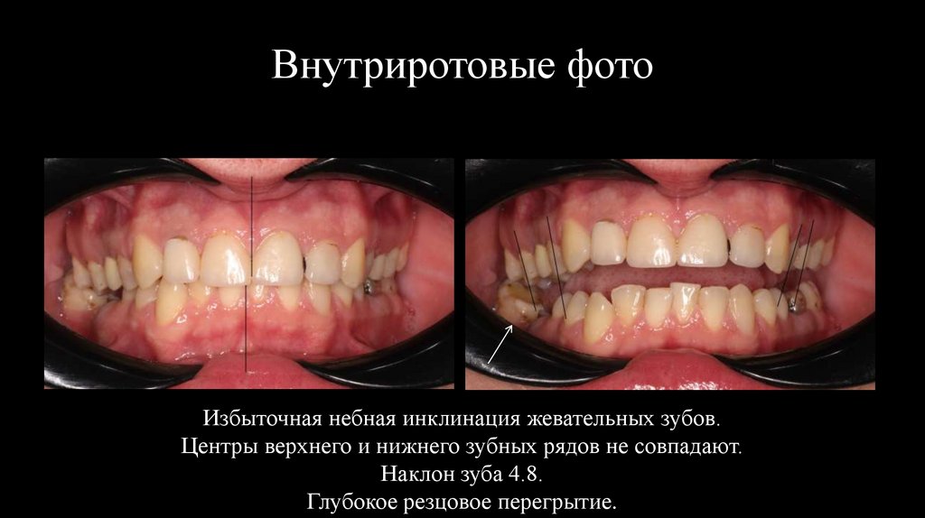 Внутриротовые фото