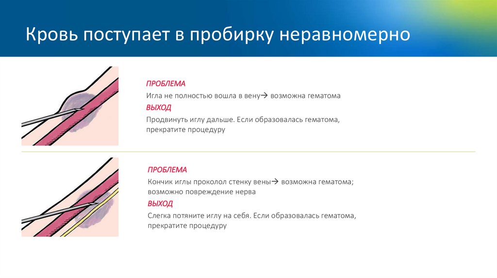 Кровь поступает в пробирку неравномерно