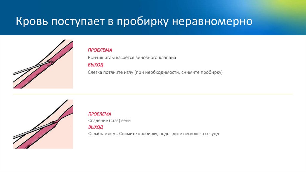 Кровь поступает в пробирку неравномерно