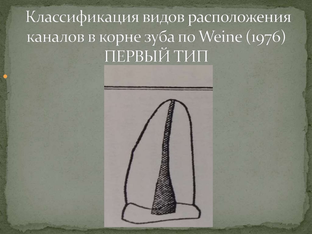 Классификация видов расположения каналов в корне зуба по Weine (1976) ПЕРВЫЙ ТИП