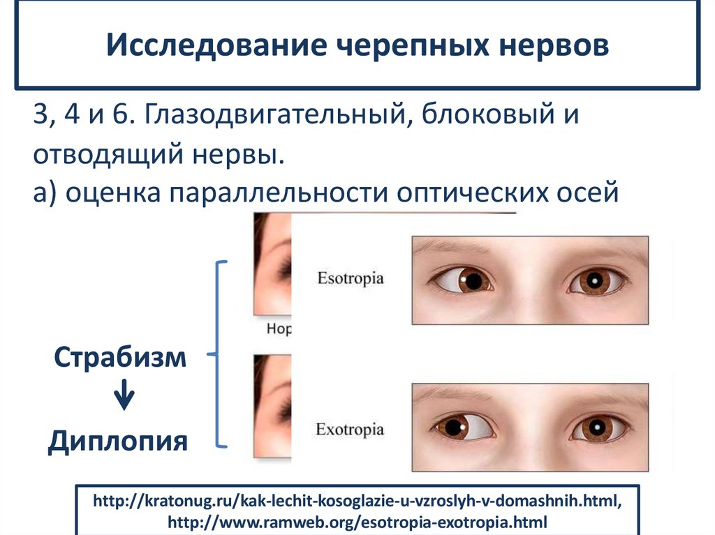 Исследование черепных нервов