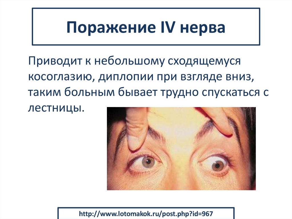 Поражение IV нерва