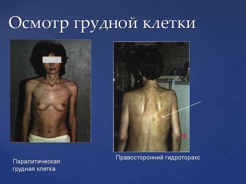 Осмотр грудной клетки