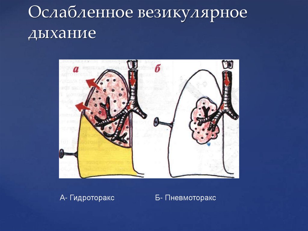 Ослабленное везикулярное дыхание