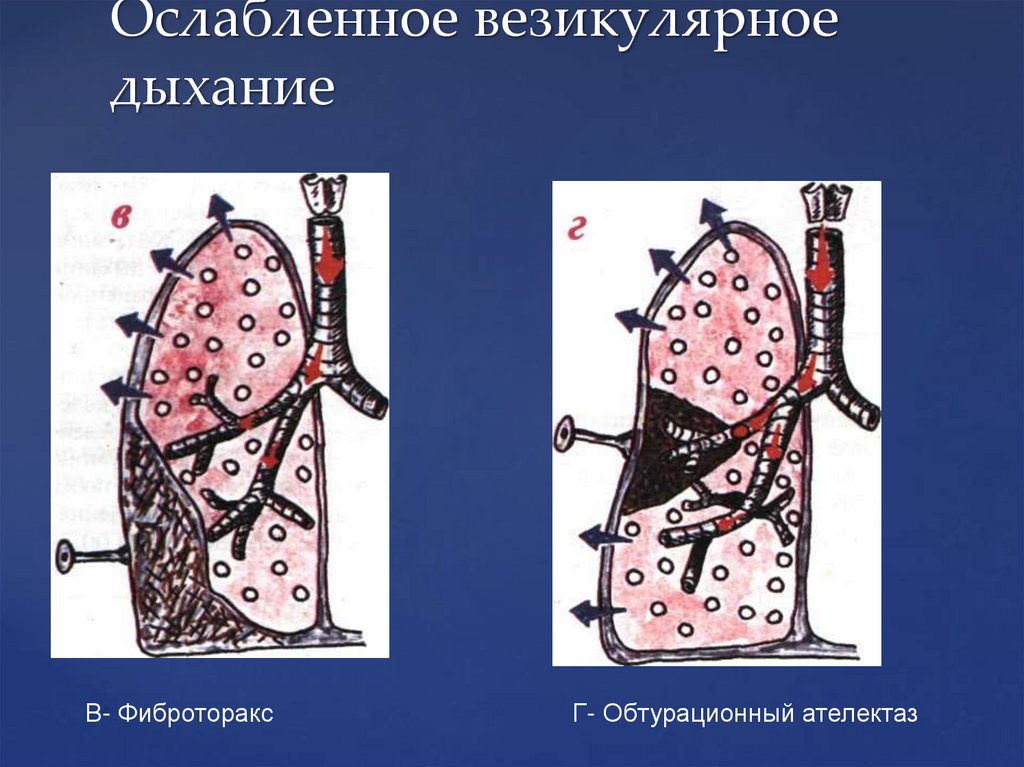 Ослабленное везикулярное дыхание