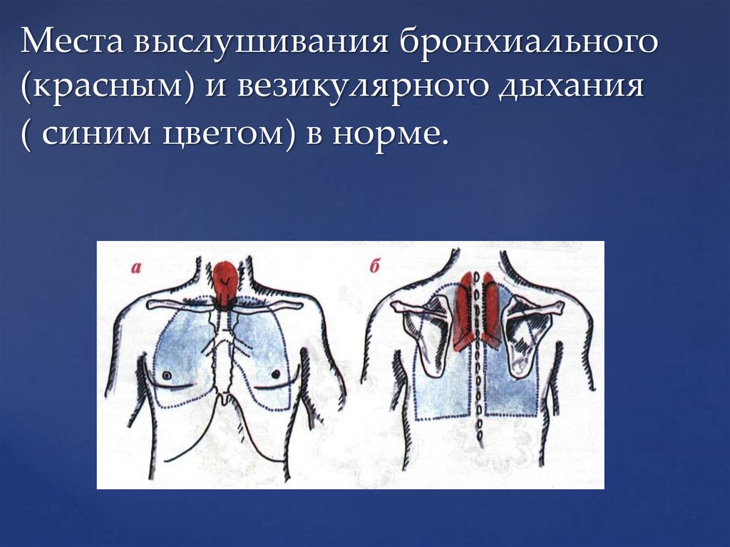 Места выслушивания бронхиального (красным) и везикулярного дыхания ( синим цветом) в норме.