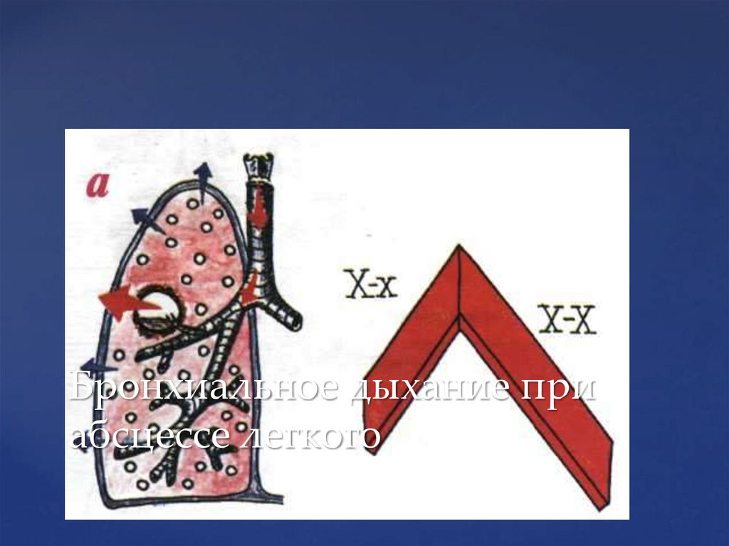 Бронхиальное дыхание при абсцессе легкого