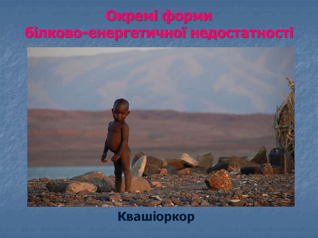 Окремі форми бiлково-енергетичної недостатності