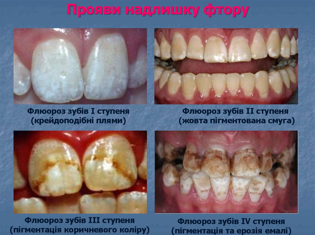 Прояви надлишку фтору