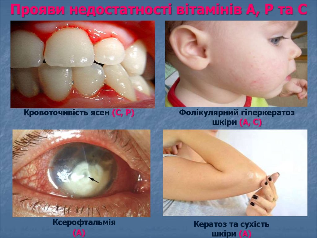 Прояви недостатності вітамінів А, Р та С