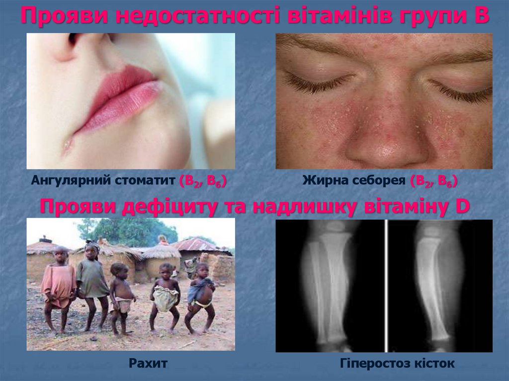 Прояви недостатності вітамінів групи В