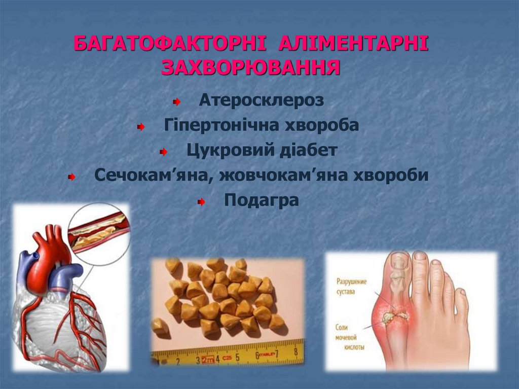 БАГАТОФАКТОРНІ АЛІМЕНТАРНІ ЗАХВОРЮВАННЯ