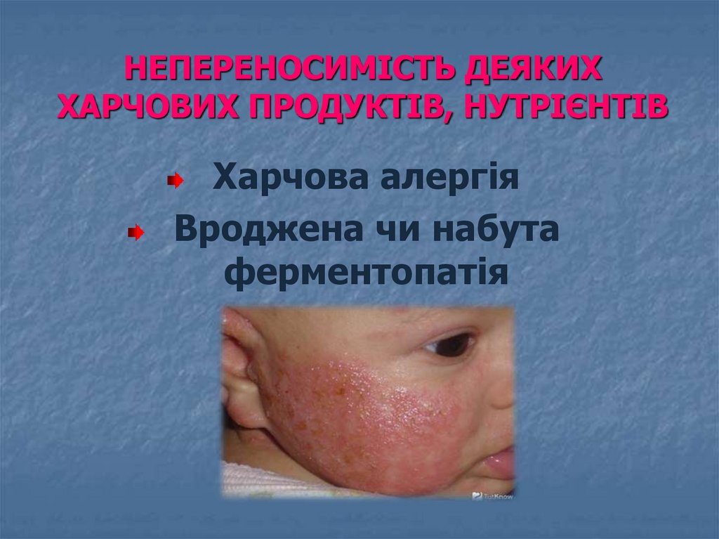 НЕПЕРЕНОСИМІСТЬ ДЕЯКИХ ХАРЧОВИХ ПРОДУКТІВ, НУТРІЄНТІВ