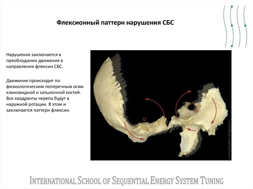 Флексионный паттерн нарушения СБС