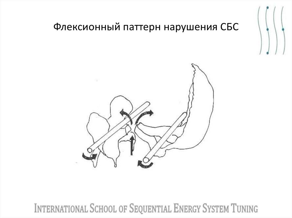 Флексионный паттерн нарушения СБС