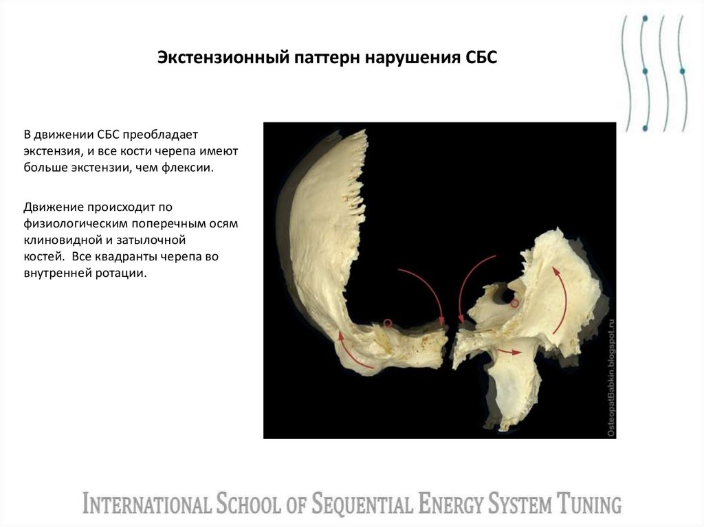 Экстензионный паттерн нарушения СБС