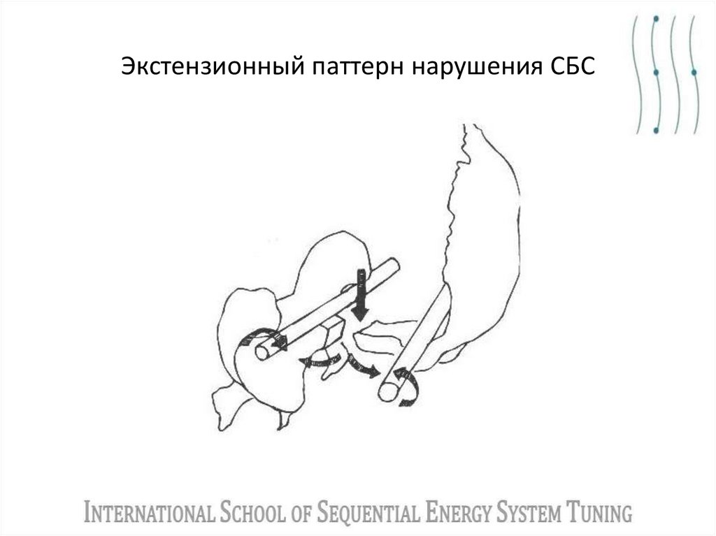 Экстензионный паттерн нарушения СБС