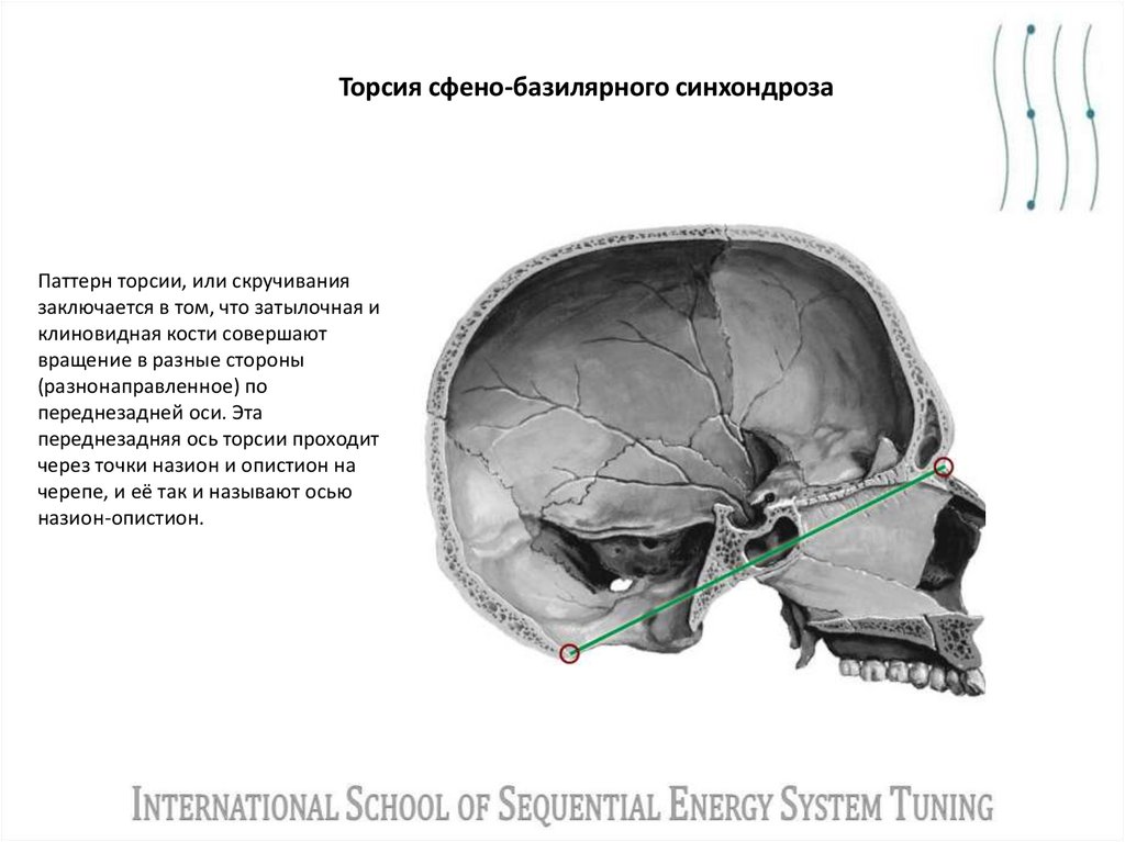 Торсия сфено-базилярного синхондроза
