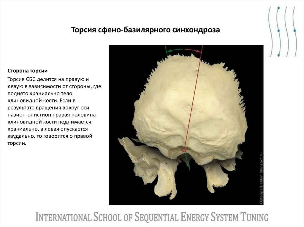 Торсия сфено-базилярного синхондроза