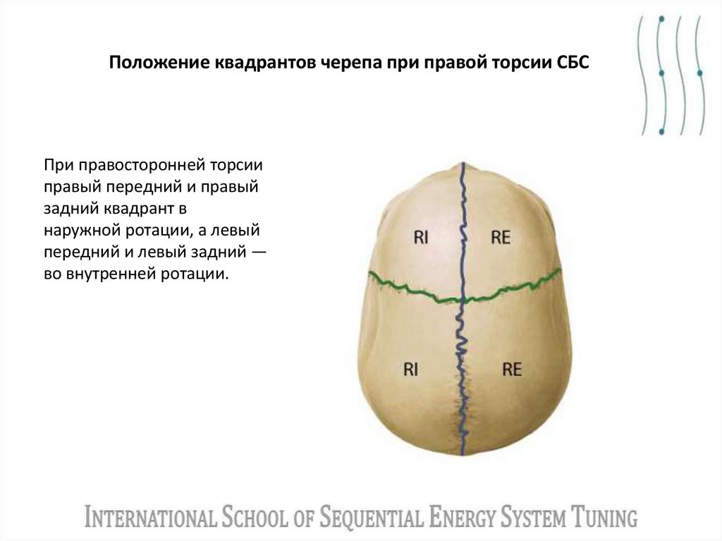 Положение квадрантов черепа при правой торсии СБС