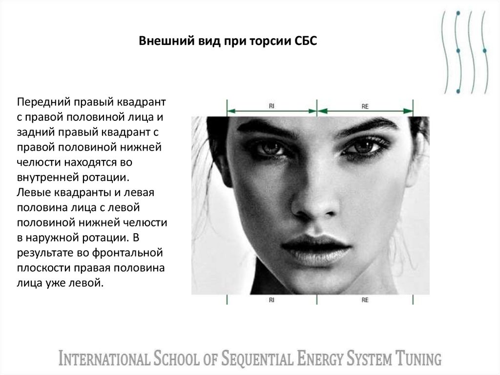Внешний вид при торсии СБС