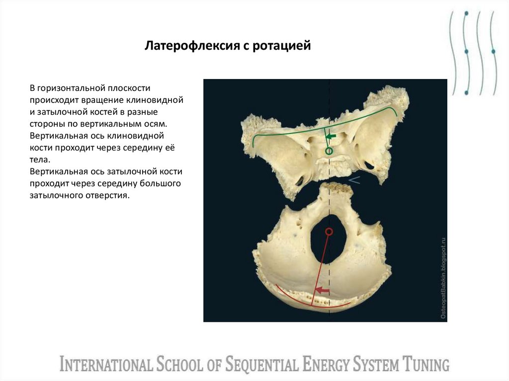 Латерофлексия с ротацией