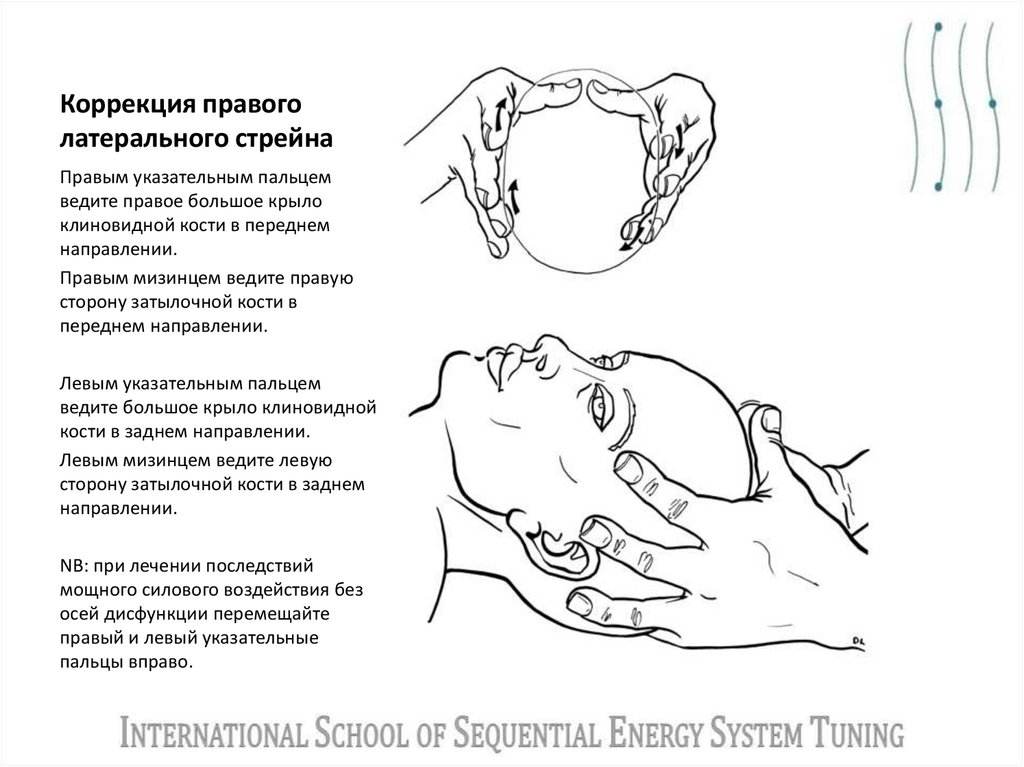 Коррекция правого латерального стрейна
