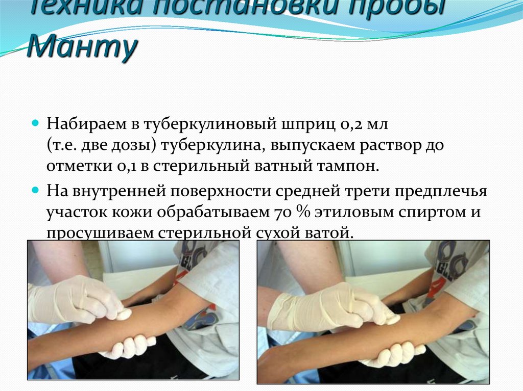 Техника постановки пробы Манту