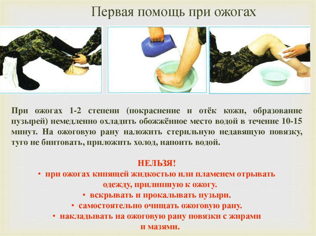Первая помощь при ожогах
