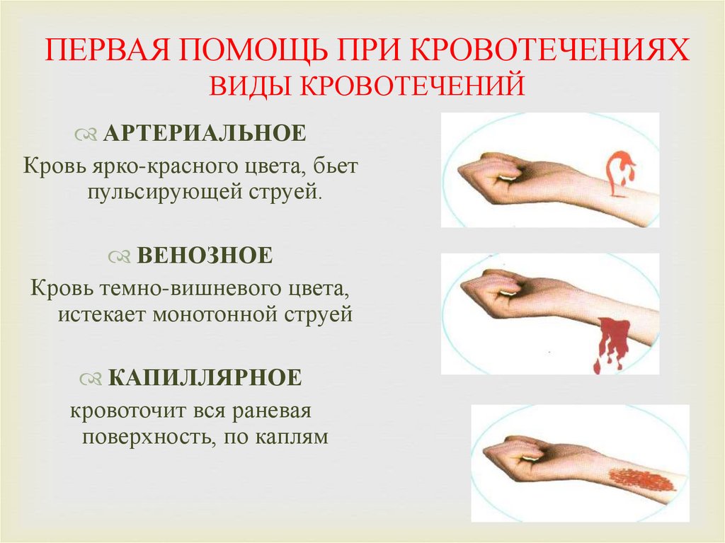 ПЕРВАЯ ПОМОЩЬ ПРИ КРОВОТЕЧЕНИЯХ ВИДЫ КРОВОТЕЧЕНИЙ
