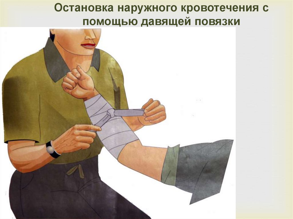 Остановка наружного кровотечения с помощью давящей повязки