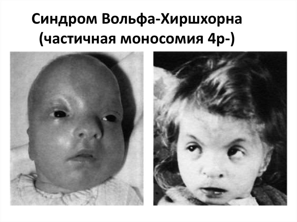 Синдром Вольфа-Хиршхорна (частичная моносомия 4р-)