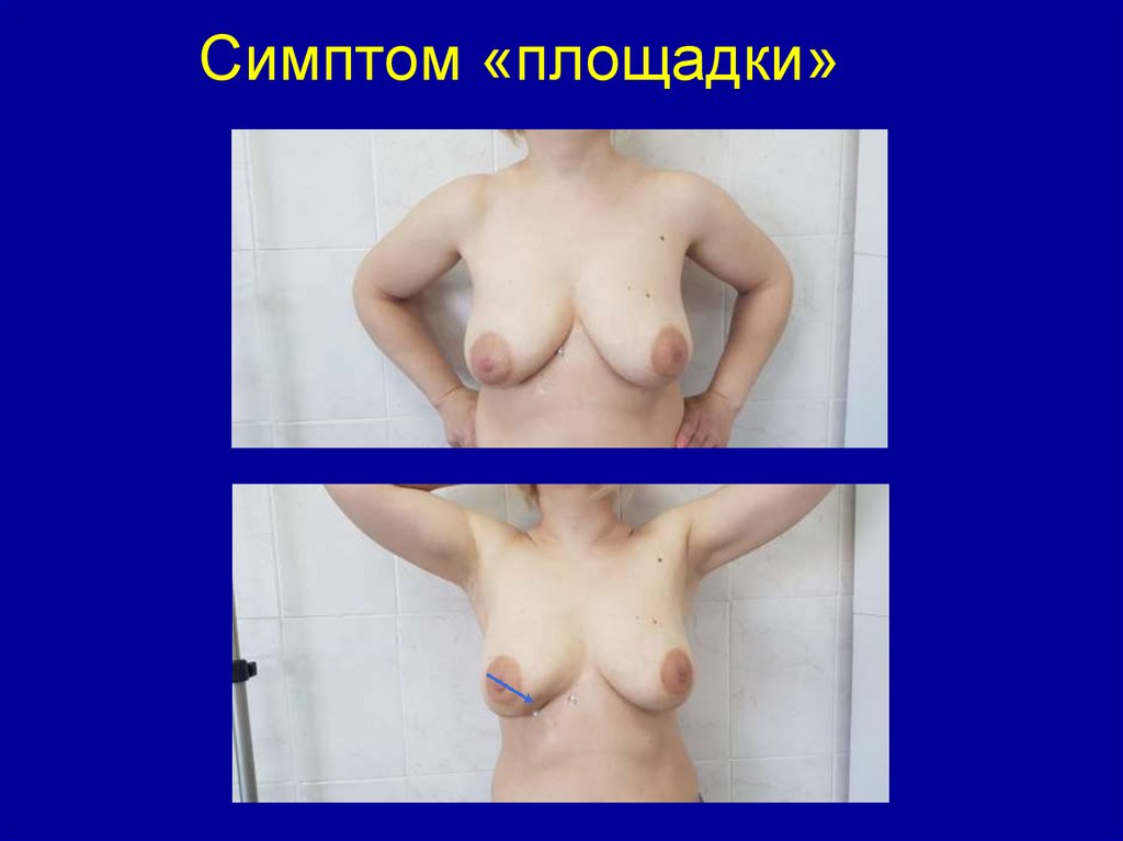 Симптом «площадки»