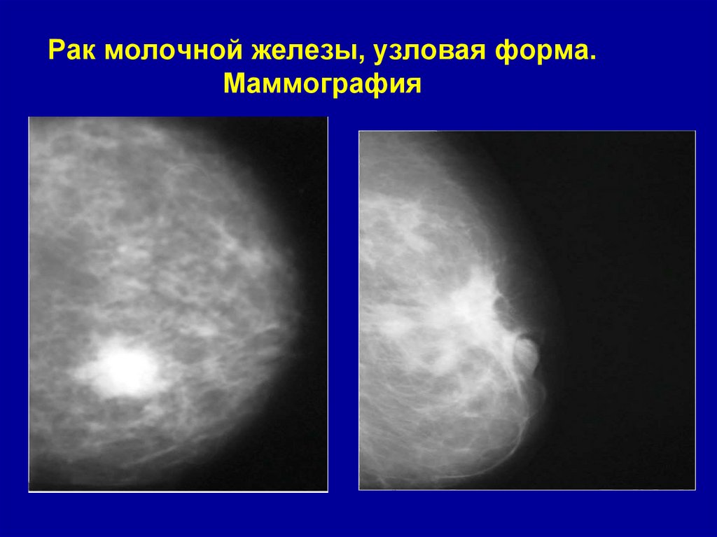 Рак молочной железы, узловая форма. Маммография